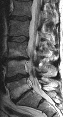 (spinal stenose) ryggsmerter