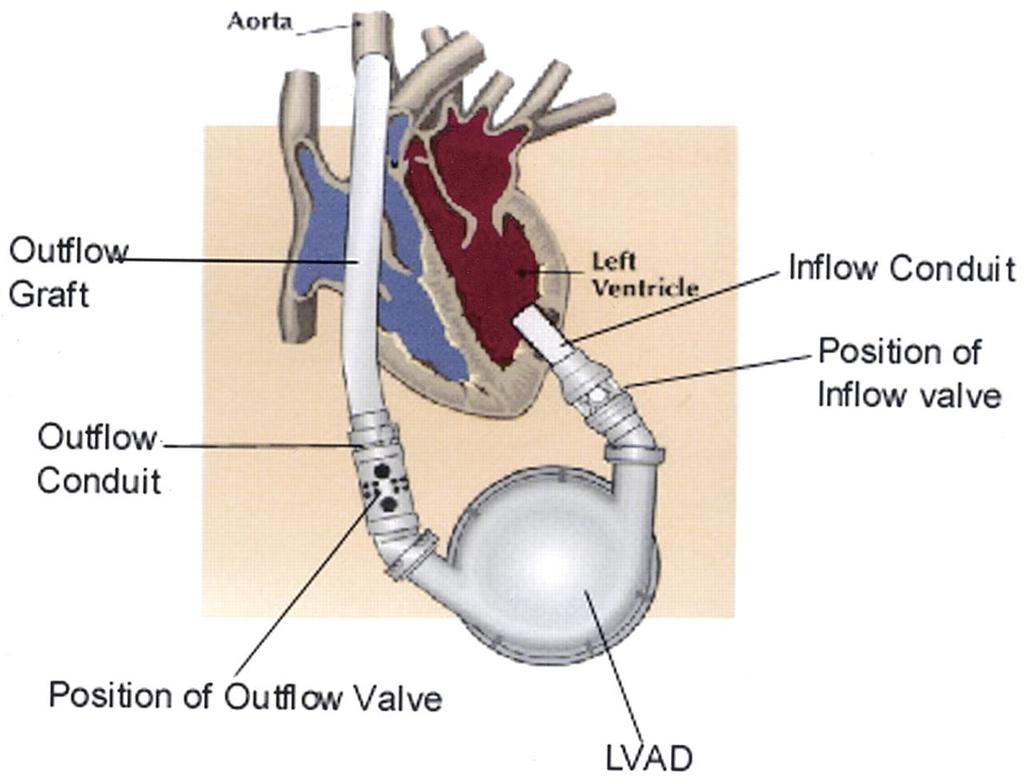 LVAD/