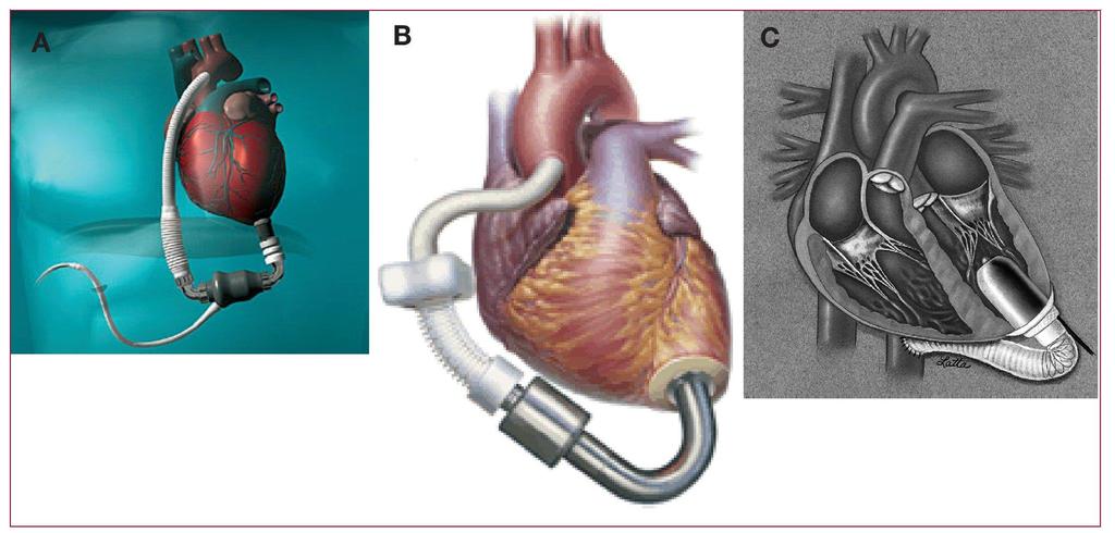 LVAD/