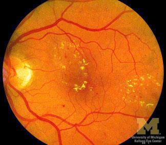 Bakgrunnsforandringer på netthinnen = non-proliferativ retinopati Skal følges med jevnlige kontroller hos