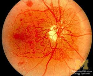 Nydannelse av blodkar = proliferativ retinopati Skal behandles!