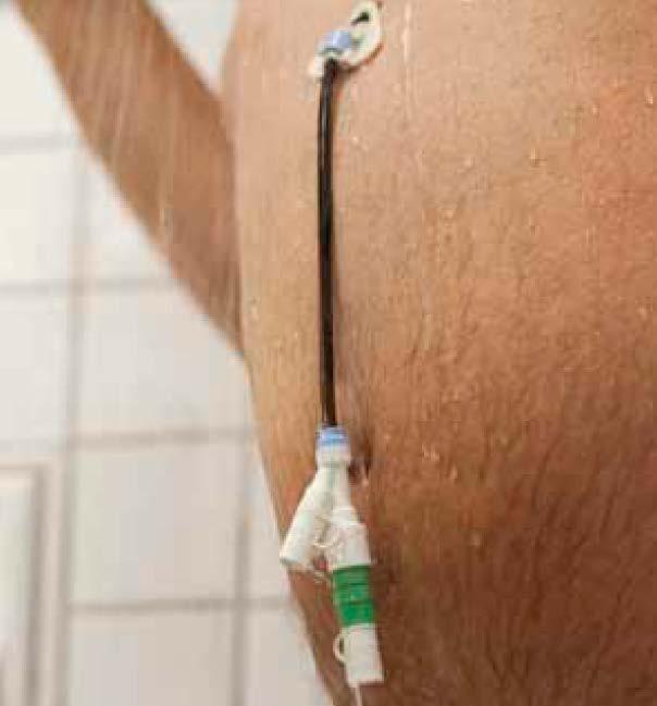 PLEIE AV STOMIEN Det lille hullet som blir laget på magen under PEG/J-inngrepet kalles en stomi. Normalt gror såret etter operasjonen på ca. 10 dager.