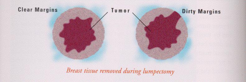Preoperativ informasjon! Preoperativ merking dersom tumor ikke er palpabel (BDS)! Mulighet for rereseksjon, evt.