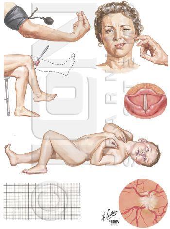 Hypokalsemisk krise S-kalsium < 1,9 mmol/l Ca 2+ < 1,1 mmol/l Symptomer Tetani med parestesier, muskelspasmer (larynx), generelle kramper