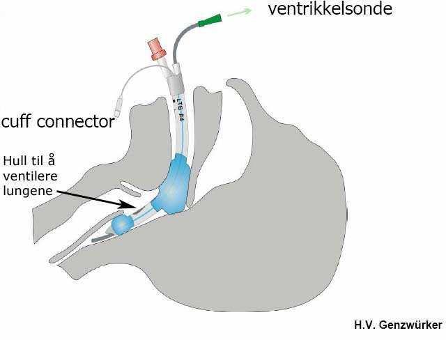 Figur 3. Dersom du er trent med å bruke en supraglottisk device f.eks. larynxtube/laryngsmaske/i-gel, er det en god måte å etablere luftveien på. Helse Bergen har denne som 1.