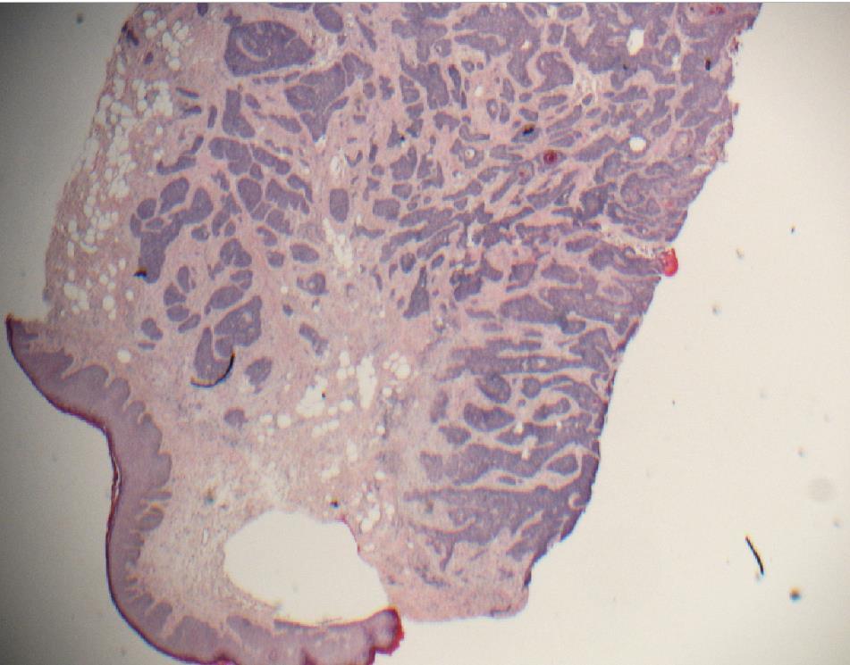 SCC, basaloid type, kvinne 65år Kom som frysesnitt HPV16+ Anal- Cyt i 2003: enkelte dyskeratotiske celler Historikk