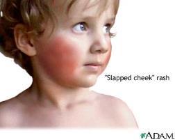 Barneinfeksjoner s 208 Vannkopper Svært smittsomt, men infeksjon gir livslang immunitet.