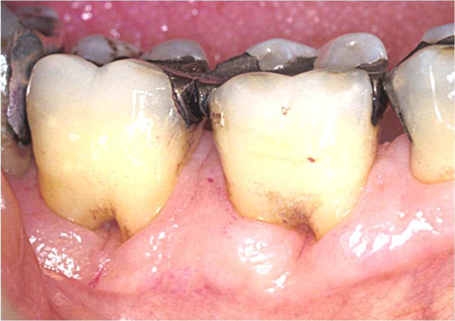 Ved å undersøke en tanns mobilitet, får en raskt et foreløpig inntrykk av festeapparatets tilstand.