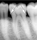 Innlegging av data: Før innlegging av data vær nøye med å ha korrekt tannstatus. Kontroller journal under status at tenner som mangler er angitt og eventuelle implantater er registrert.