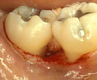 Hva er hensikten med periodontal kirurgi?