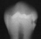av dentintykkelsen) Grad 5 (A5): Lesjon i indre tredjedel av dentinet.