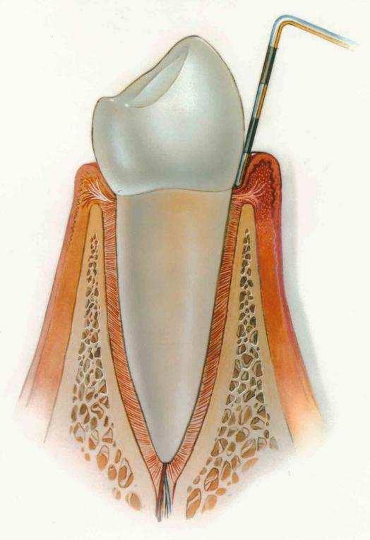 Periodontitt kjennetegnes ved nedbryting av periodontale fibre og bein, apikalvekst av kontaktepitel og fordypning av den gingivale sulcus. Det dannes en periodontal lomme.