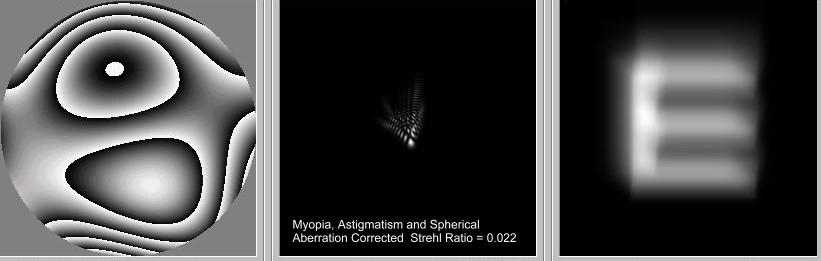 SA Population Distribution.7.6 n = 838 Spherical Aberration vs Spherical Refractive E Pupil Size = 6.mm.5 Spherical Aberration - 