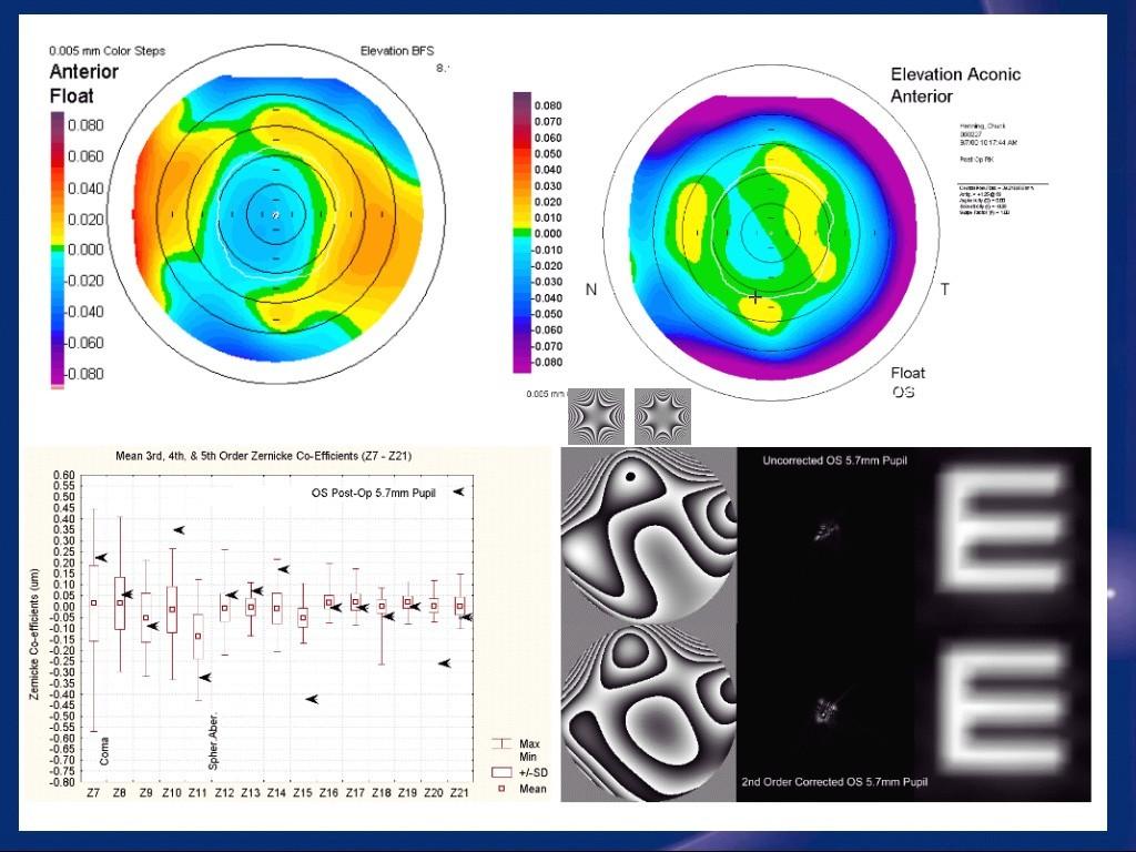 Wavefront PSF 3mm Pupil 6mm Pupil Convolution Her er enda et enkelttilfelle, og om dere ser på Orbscan-bildet av den fremre overflaten oppe til venstre, ser dere at midtsonen har blitt gjort flatere