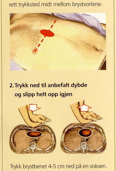 Brystkompresjoner - teknikk Trykk brystbenet ned ca 5 cm midt mellom brystvortene 30 kompresjoner Frekvens: ca 100 pr.