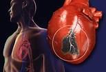 Mistanke om hjerteinfarkt Sterke smerter i brystet i mer enn 5 min.
