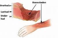 Hverdagsulykker Etseskade (syre, lut, soda, sterke vaskemidler) På hud: