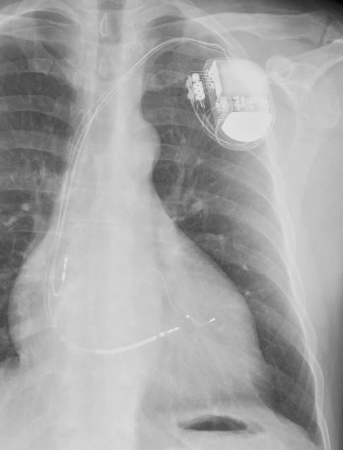 Ikke en ØH undersøkelse Henvises på vanlig måte med opplysning om type pacemaker/icd Pacemaker / ICD Finnes pacemakere / ICD er som er Conditional Kan trygt ta MR når en rekke retningslinjer blir