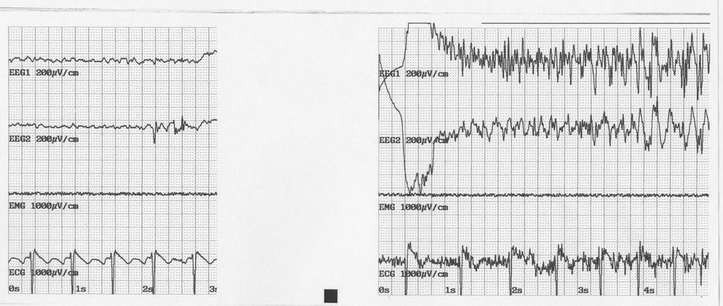 Ideelt EEG-anfall Kvinne 30 år med postpartum depresjon uten effekt av 4 måneder med høydose venlafaxin.