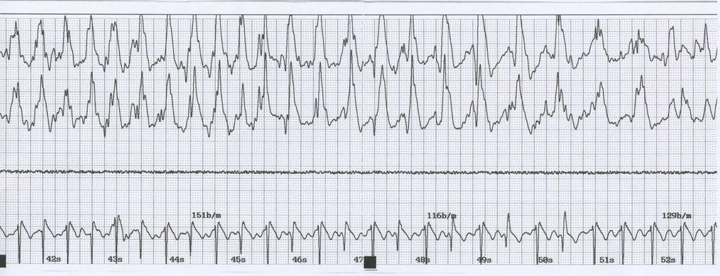 Ideelt EEG-anfall Kvinne 30 år med postpartum depresjon uten effekt av 4 måneder med høydose venlafaxin.