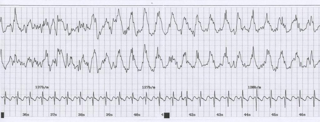 Bra EEG-anfall gradvis slutt Mann 65 år med bipolar depresjon.
