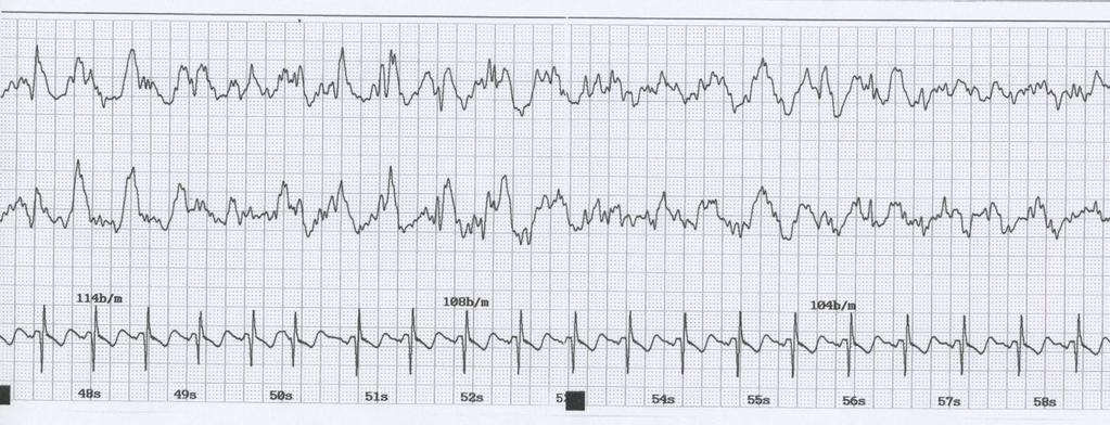 Bra EEG-anfall gradvis slutt Mann 65 år med bipolar depresjon.