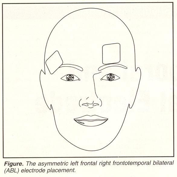 Bifrontal LART: Left Anterior Right Temporal Letemendia FJJ, Delva NJ et al.