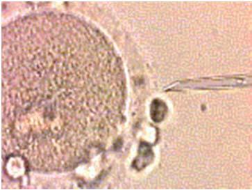 fødsel i verden 1983 Preimplantasjons genetisk diagnostikk - PGD Teknikk som brukes i forbindelse med IVF for å undersøke om ebryoet er