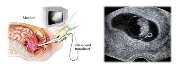 Ved IVF (Tromsø) UL undersøkelse i 1.trimester Måles s hcg: Ved ferskt embryo: 22 dager etter egguthenting (OPU). Ved frossent embryo: 18 dager etter innsetting (FER). Altså omkring uke 5.