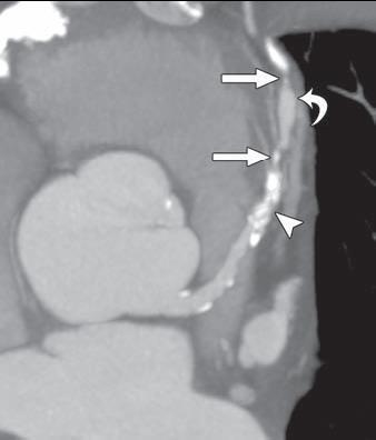 Computed tomografi (CT) Coronary artery calcium score Multi-detector or multi-slice CT (MDCT).