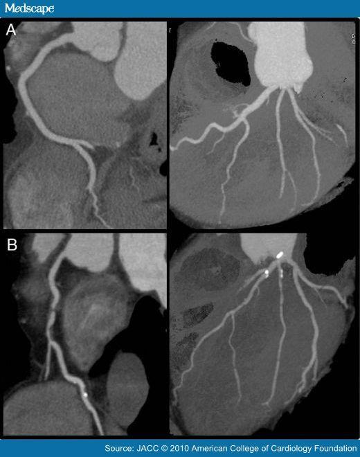 CT Angiography Intra-venous contrast to visualize the coronary arteries Advantage: Non-invasive.