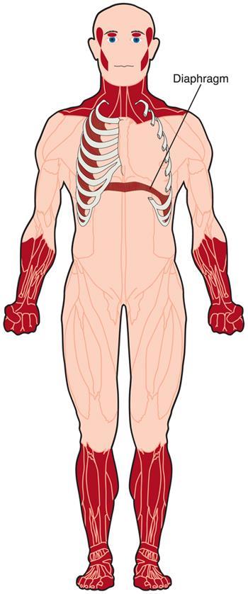 Muskler som blir svake ved DM1 Muskelkraften forbedres i barneårene og når et platå i puberteten og blir deretter gradvis