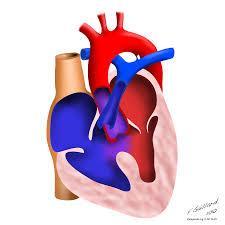 Hjertepåvirkning ved DM «Myotonic dystrophy and the heart» 2002;8:665-6670 Hjerteproblemer kan være første symptom på DM Jo flere CTG repetisjoner jo større risiko for
