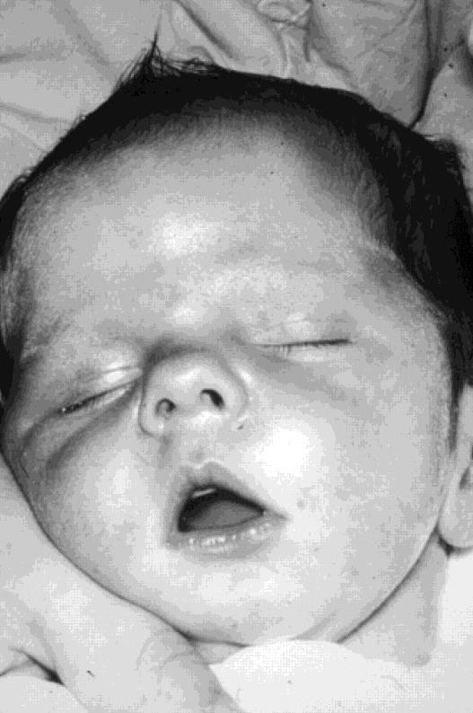 Medfødt Dystrofia Myotonika Symptomer (i fosterlivet) ved fødsel