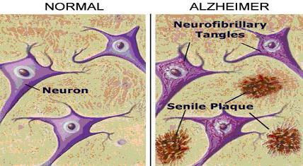 Alzheimer s sykdom, den vanligste formen for demens Pathological hallmarks xtracellular enil plaque containing beta amyloid ntracellular: eurofibrillary tangles compoused of hyperphosphorylated tau