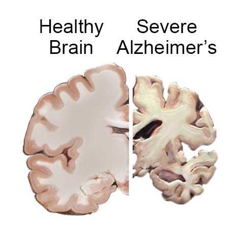 ALZHEIMER Opp til 40 % med Alzheimer opplever psykotiske symptomer Hovedsakelig