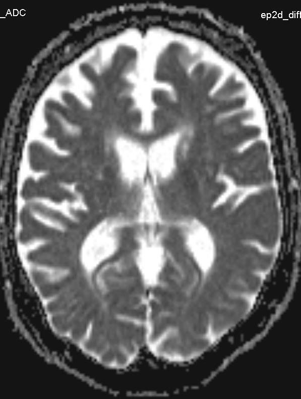 Vaskulær Slag/infarkt Cerebral amyloid angiopati Durale A-v fistler (DAVF) Sinusvenetrombose