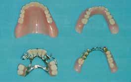 5.3 Brukere med egne, naturlige tenner og tannproteser (hel- og delproteser) Delproteser erstatter NOEN tapte tenner og festes på gjenværende, naturlige tenner.