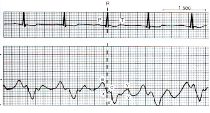 SVT - CVP SVT - sentralt venetrykk = CVP - central venous