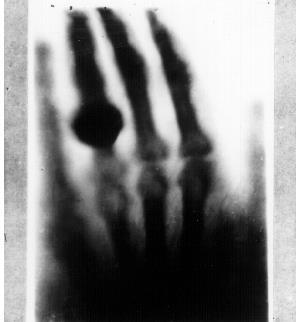 Verdens første røntgenbilde