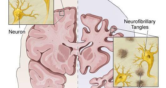 Neurofibrillære floker,