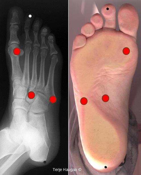Bilde 4. Viser foten inndeling etter intervaller 1-3. 2.1 Fotens referansepunkter. 5 Referansepunktene er Os cuneiforme intermedium.