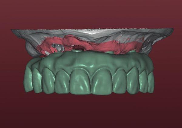 Design for sementering av single kroner CAD/CAM fremstilte kroner med kopiert design fra fil av temporær bro Gingival oppbygging i kompositt Titanskjelett er goldshaded.