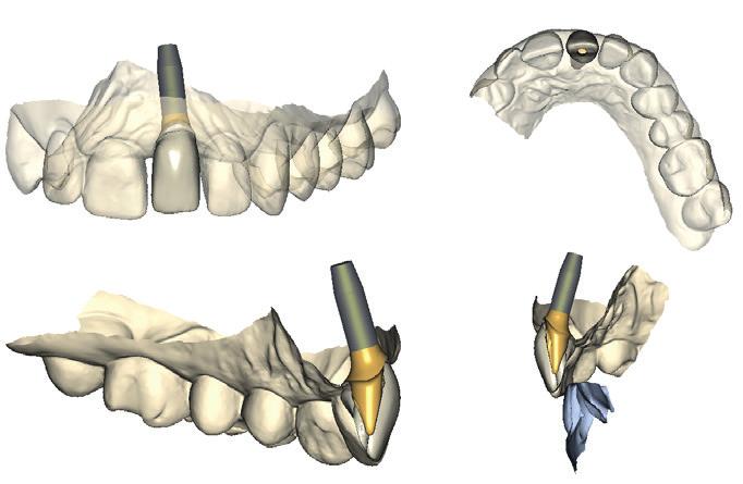 Implantater ATLANTIS CUSTOM BASE CROWN Individuelt utformet titandistanse/-base i