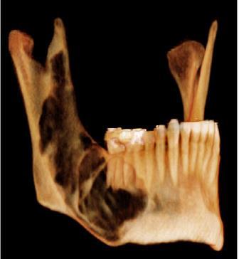 CBCT (konisk stråleformet computer tomografi) er en radiologisk teknikk for 3D fremstilling i tann, kjeve- og