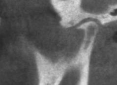 CBCT Cone Beam CT Spesialutviklet for tann,