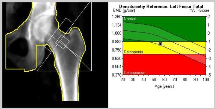 Retningslinjer Røntgen og beinmineraltetthet Vanlige røntgenbilder kan ikke benyttes for å vurdere beinmineraltetthet. Vanlige røntgenbilder er nødvendig for å påvise kompresjonsbrudd.