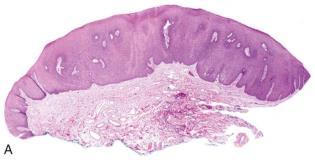 enkeltcellekeratinisering.