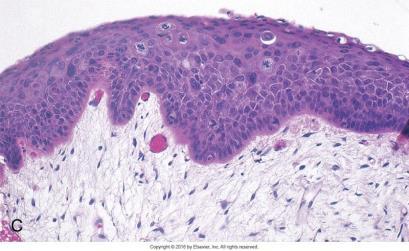 dyskohesjon, mitoser Cytologisk atypi med