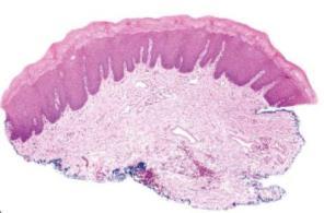 Histologi: parakeratinisering, keratinocyttødem, «chevrons»